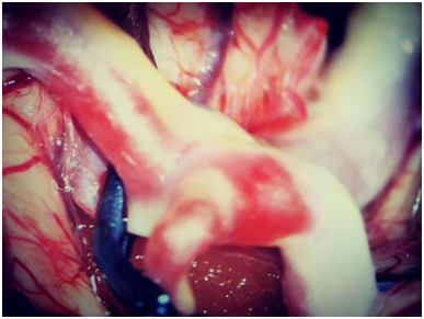 动脉瘤夹闭术后