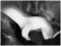 在荧光造影下评估动脉瘤夹闭后情况